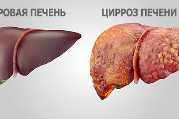 Цирроз печени